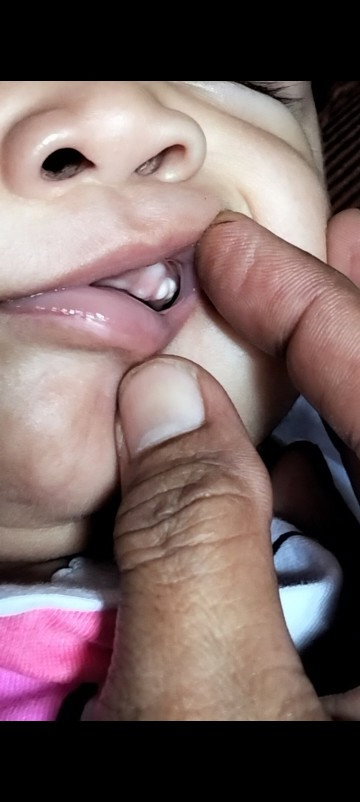 Bayi 3 bulan ada putih putih di gusinya apakah normal?