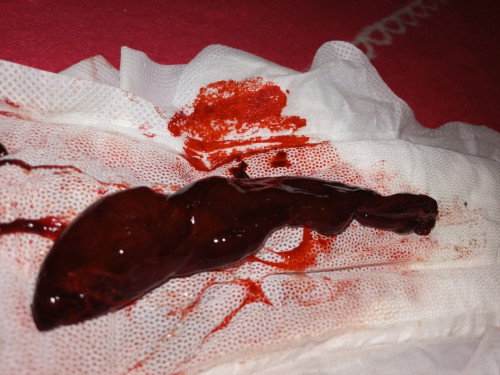 is this miscarriage?
