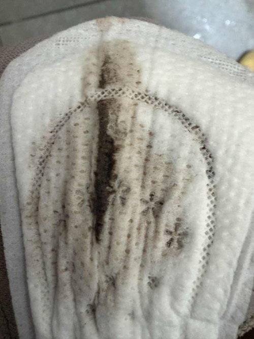 Vaginal discharge