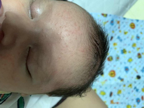 ตุ่มขึ้นบนหน้าลูก