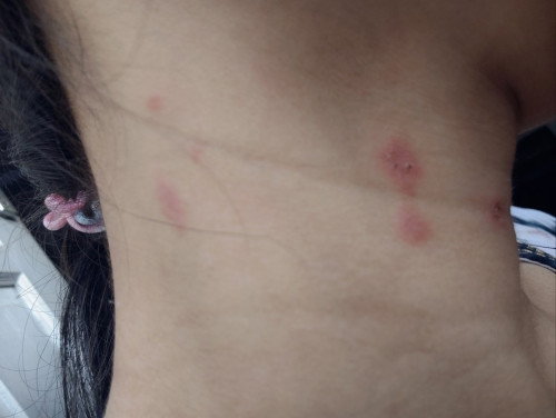 Ini herpes bukan ya