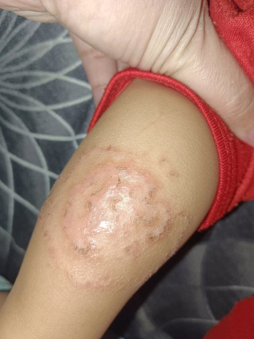 Ada pada kaki bayi 8bulan