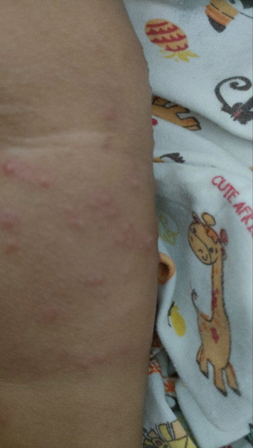 Bun ,,ini kenapa ya anak saya habis demam kok malah timbul  bentol kayak gini dan ada airnya gitu 😭