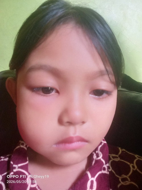 Bengkak pipi