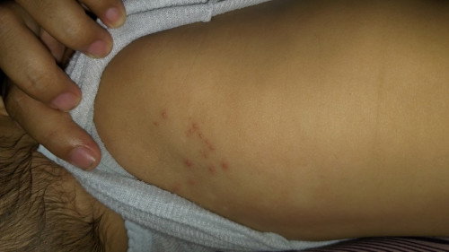 Bintik bintik kecil di punggung bayi