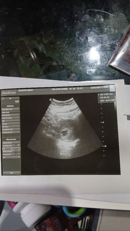 Usia hpht gak sama dengan usg