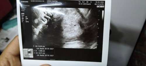 Upt negatif,scan pregnant.