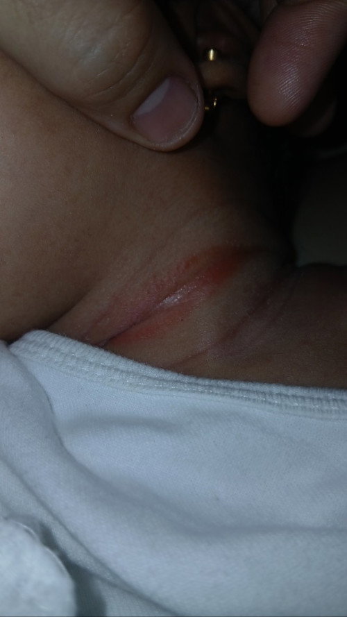 neck rash ni baby