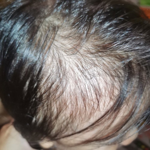 Normal lang ba sa 3yrs old magkahairfall