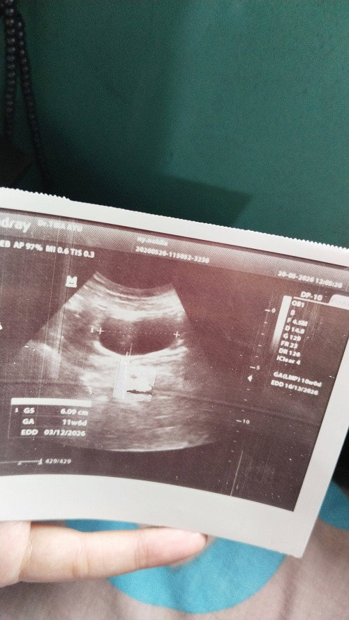 USG di usia kandungan 8 week da 10 week