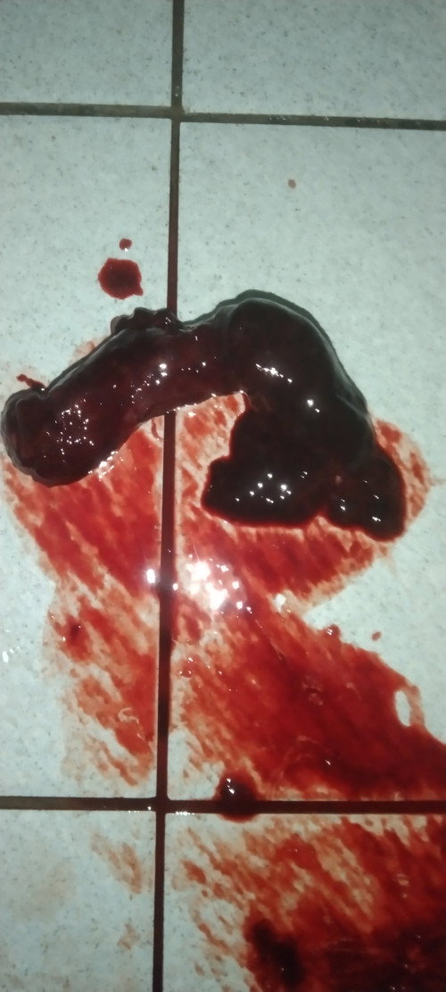 Hamil 7minggu pendarahan 
Ada tak macam saya darah ketulan mcm,tp breasts still sakit,