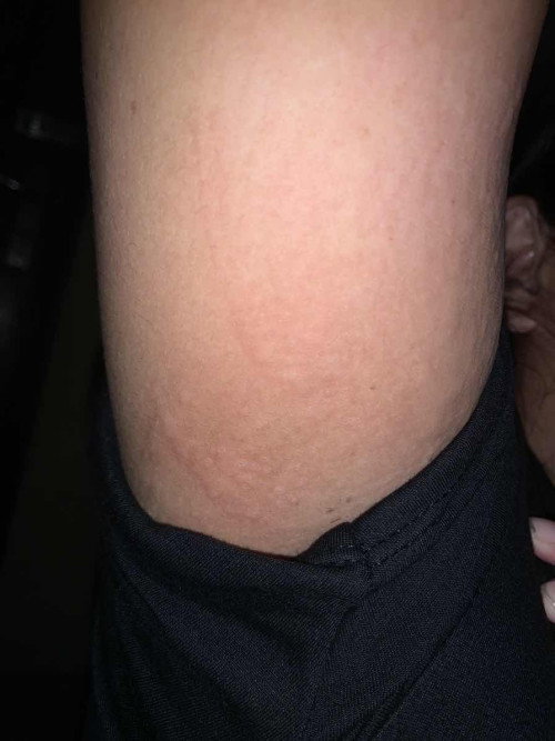 Bun mau tanya ada yg sama ga hamil 16minggu badan suka gatel kaya gini