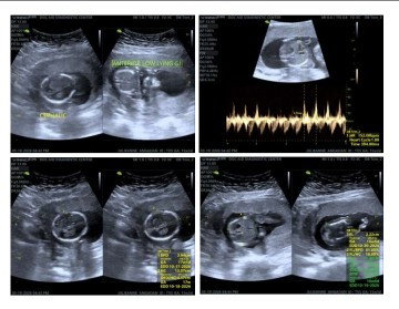 First baby, 19 weeks preggy