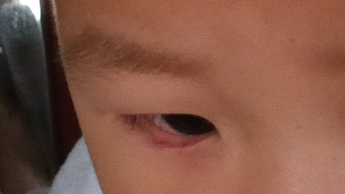 mata anak merah