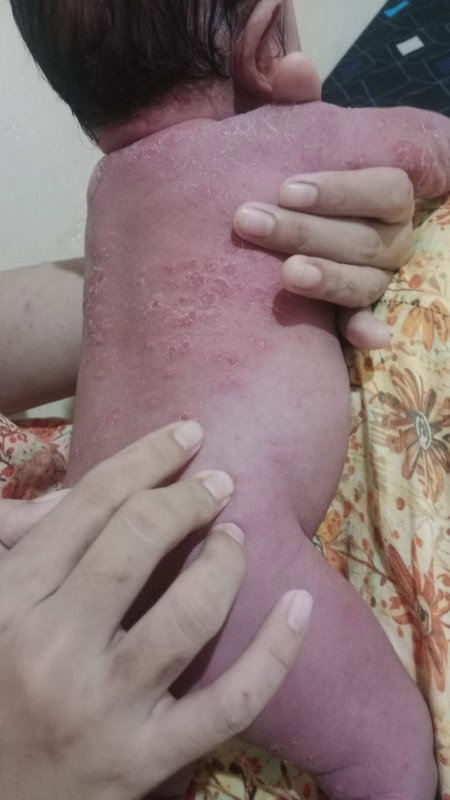 Bayi bruntusan berujung kulit ngelupas