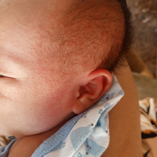 Kailan mawawala ang acne bumps ni baby?