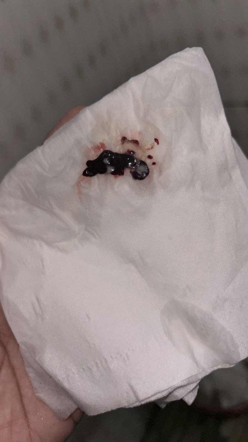Flek coklat tua lalu keluar sedikit darah, perut kram spt haid hilang timbul