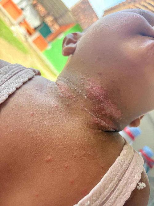 Biang Keringet atau alergi ya