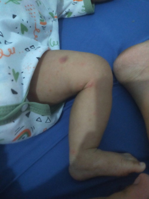 bayi diagnosa alergi susu sapi