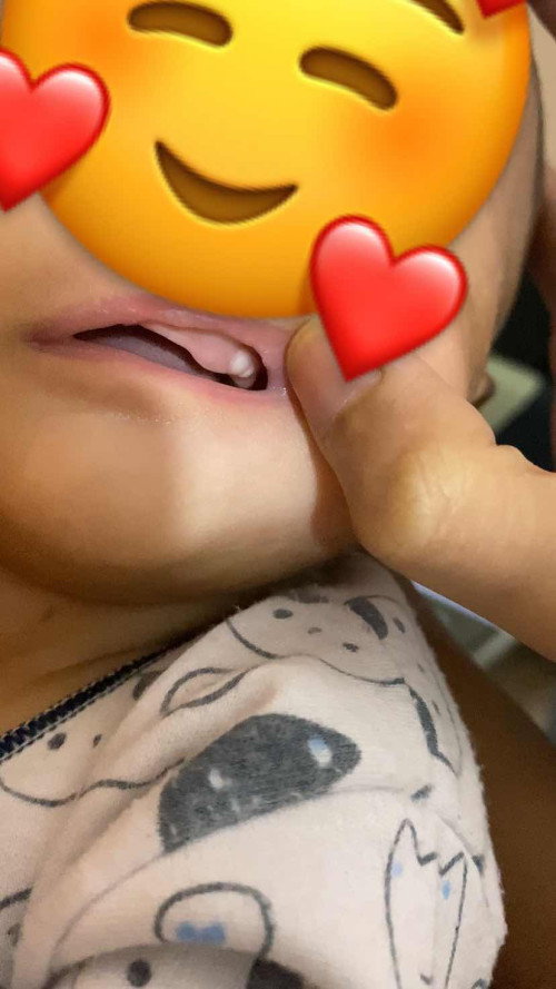 Tumbuh gigi usia 2 bulan