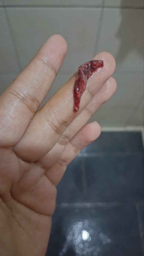 Gumpalan darah atau apa?