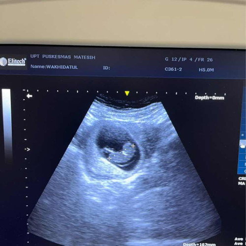 Usg di puskesmas 10 week 4 day