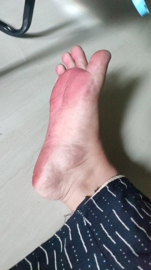 Telapak kaki merah