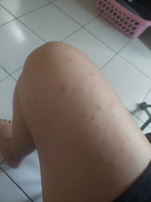 Peradangan kulit atau dermatitis