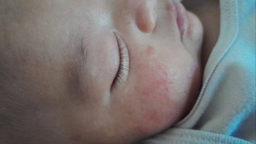 Baby 2 bulan bruntusan merah