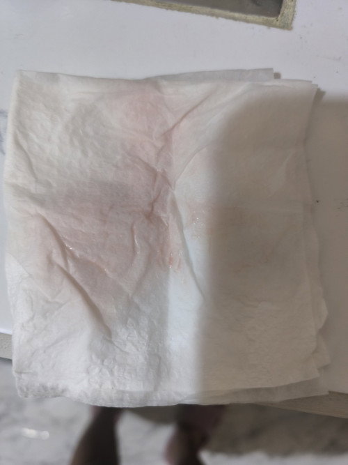 Vaginal Discharge