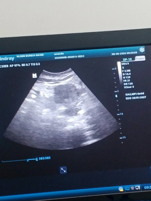 Hasil USG 8 Juni, UK 6w6d