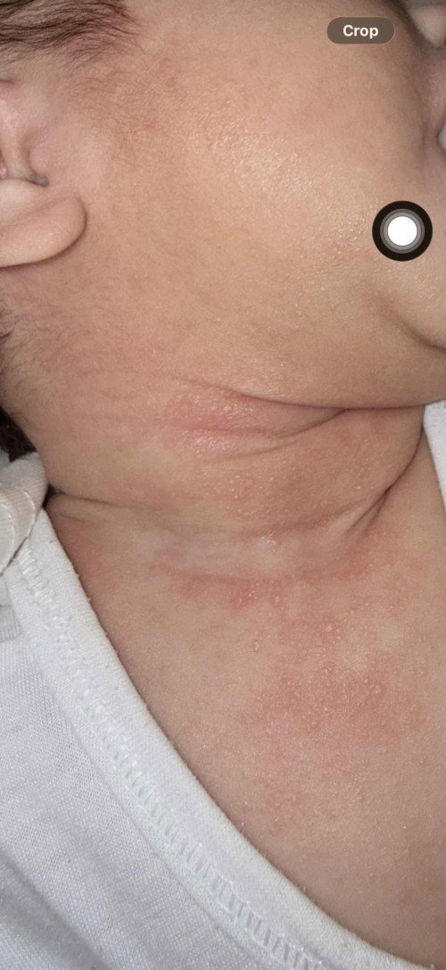 NECK SKIN RASH