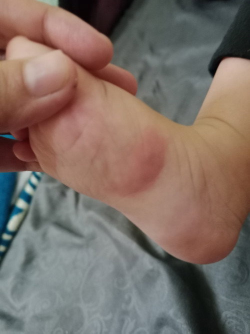 Anak saya bentol mau seminggu belum hilang