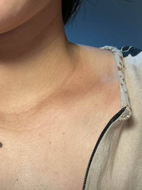 tumbuh skin tag
