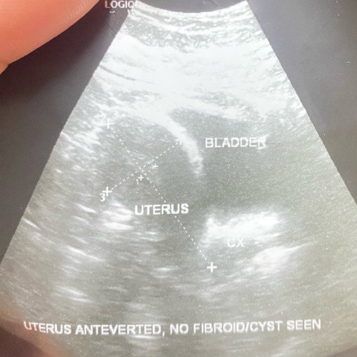 Ingat pregNant