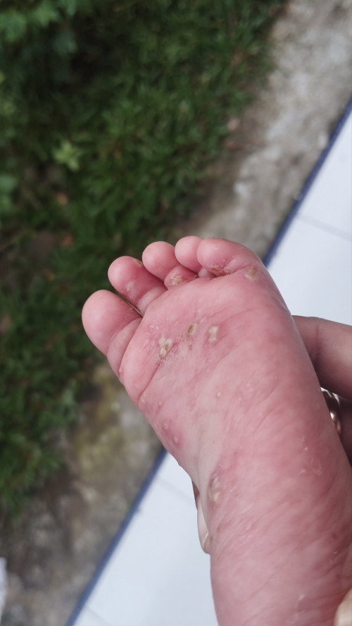 Telapak kaki bernanah