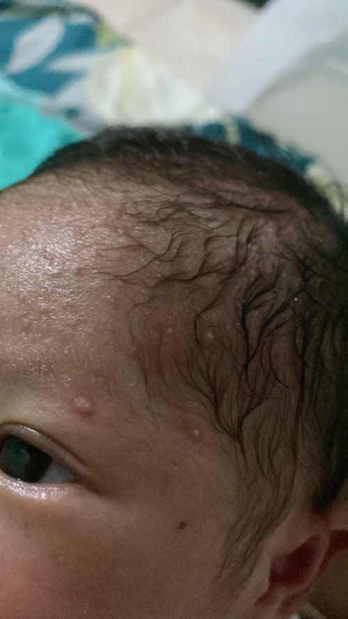 Jerawat bayi bernanah dan bau