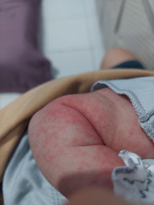 kemerahan pada lipatan tangan bayi