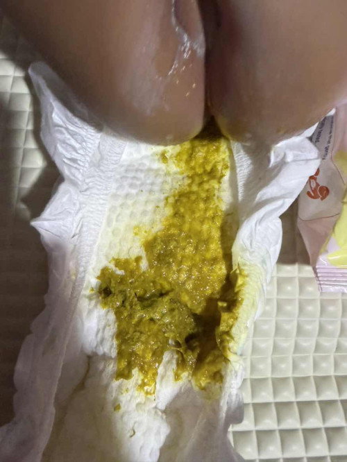 Loose stool in 5 month old baby