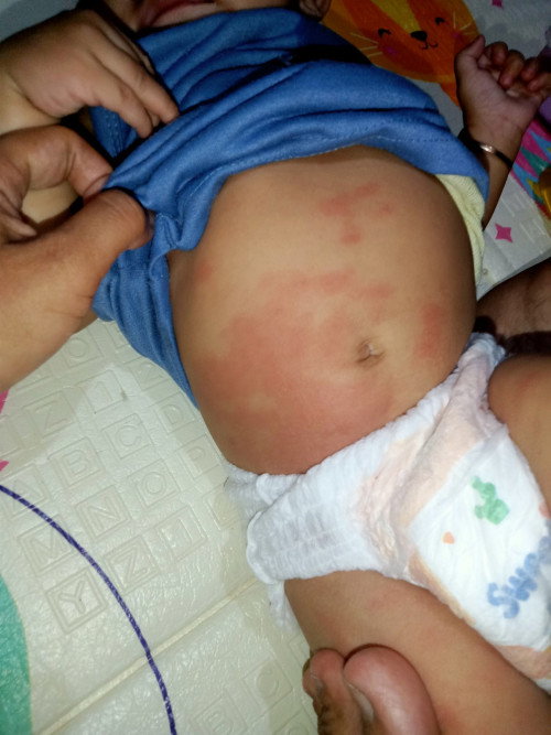 Muncul ruam merah setelah sehari imunisasi