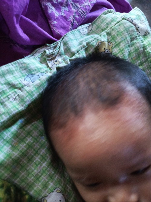 Cara mengatasi beruntusan pada bayi 3 bulan dong Bun