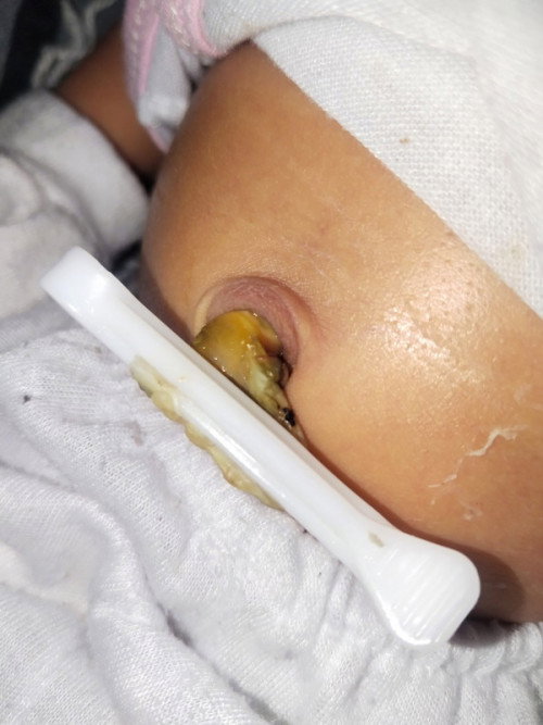 UMBILICAL CORD