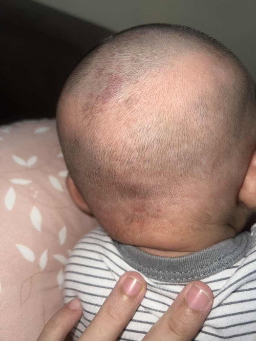 Merah dibelakang kepala bayi