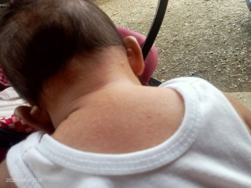 Rashes ni baby