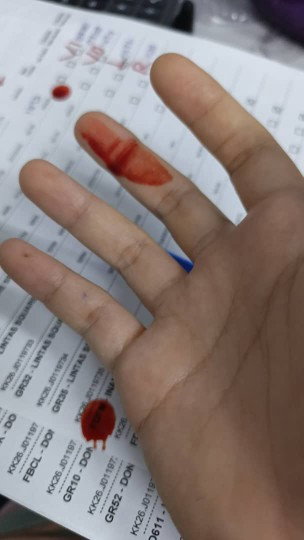 nosebleed TM2