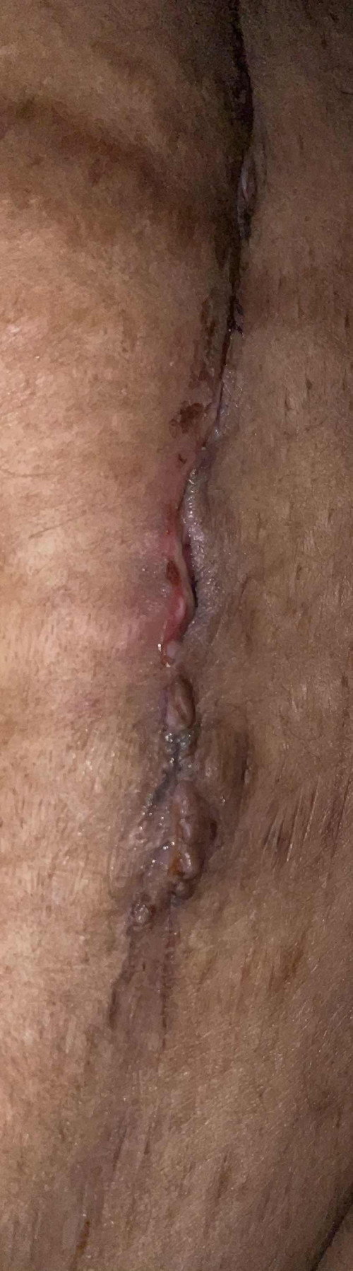 Luka Czer 8 hari