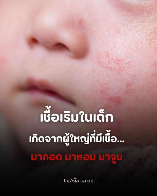 เชื้อเริมในเด็ก