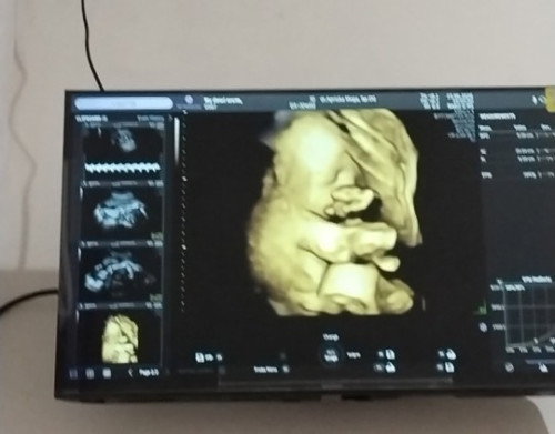 Hpl 20 Agustus...USG 4d dedek bayi selalu nutupin muka nya...