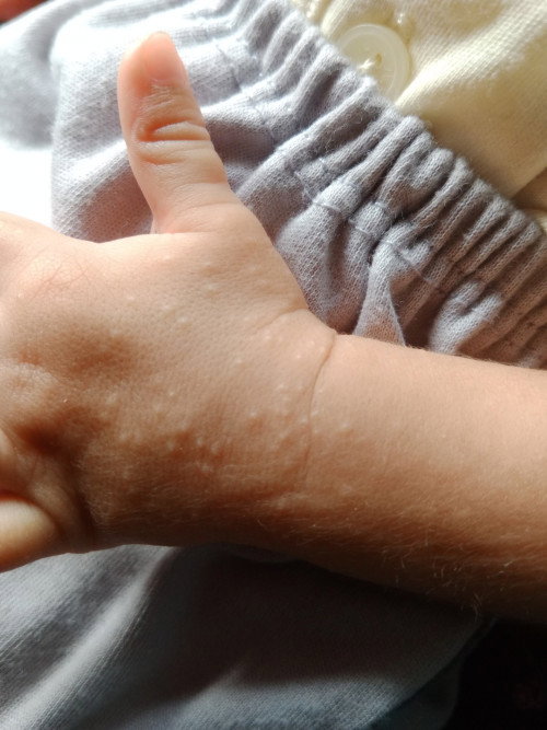 Bintik putih kaki & tangan