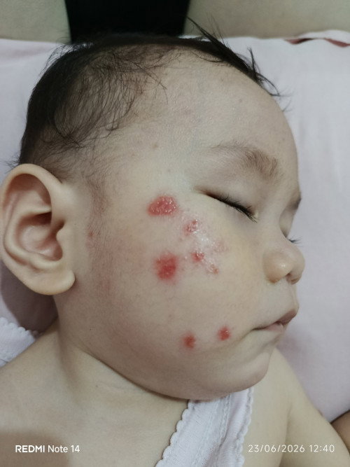 Sharing Mom, luka pada wajah anak merah berair dan menyebar,awalnya digigit nyamuk